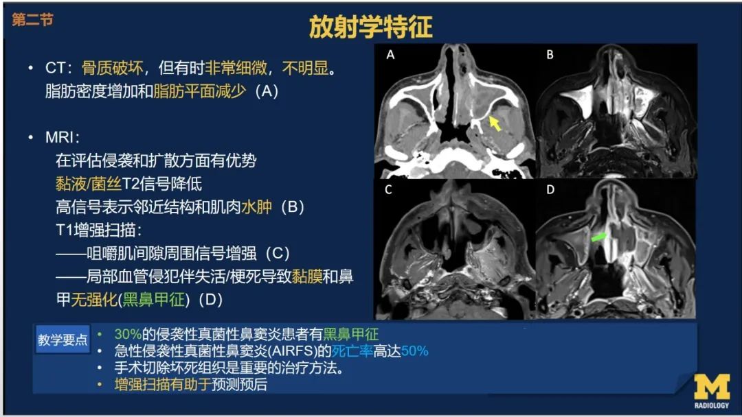 影像PPT - 【PPT】致命的真菌：头颈部侵入性真菌感染-14