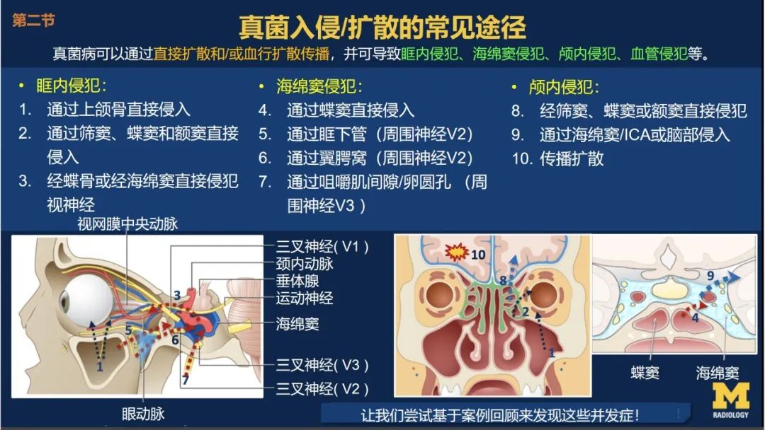 影像PPT - 【PPT】致命的真菌：头颈部侵入性真菌感染-18