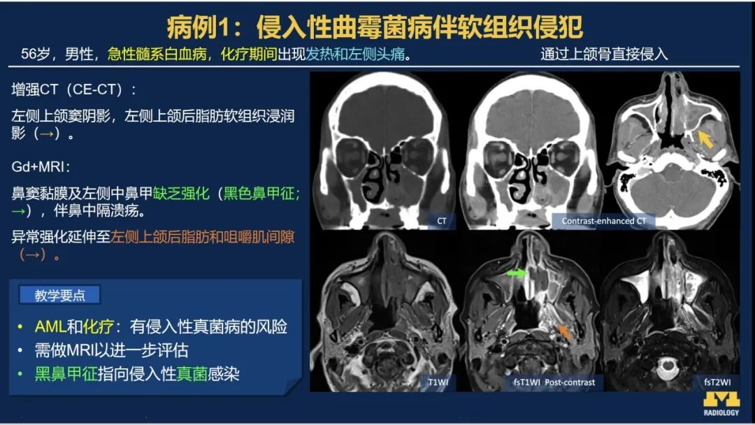 影像PPT - 【PPT】致命的真菌：头颈部侵入性真菌感染-20