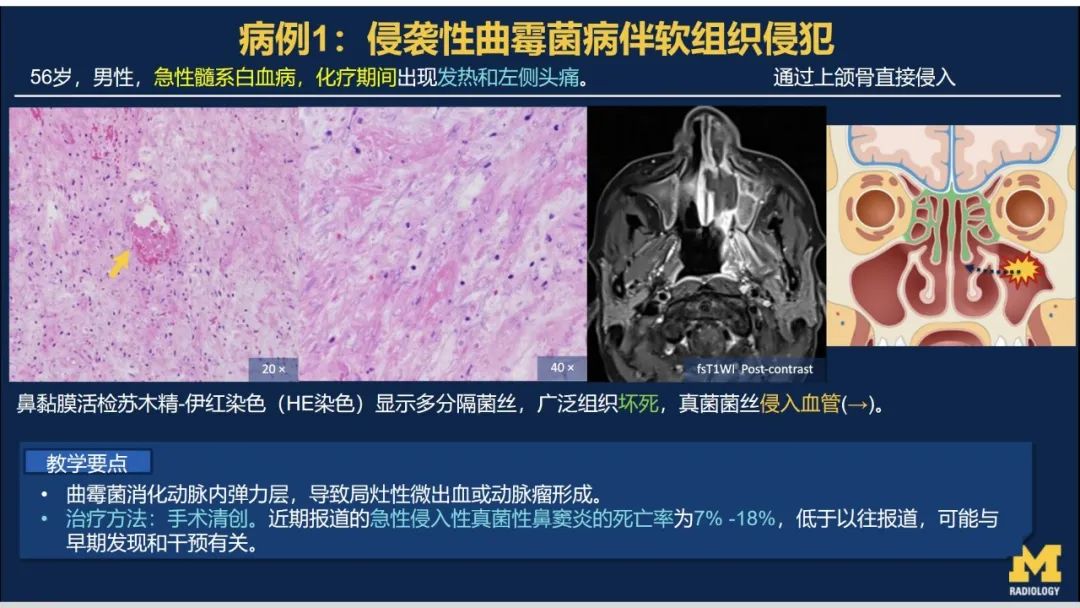 影像PPT - 【PPT】致命的真菌：头颈部侵入性真菌感染-22