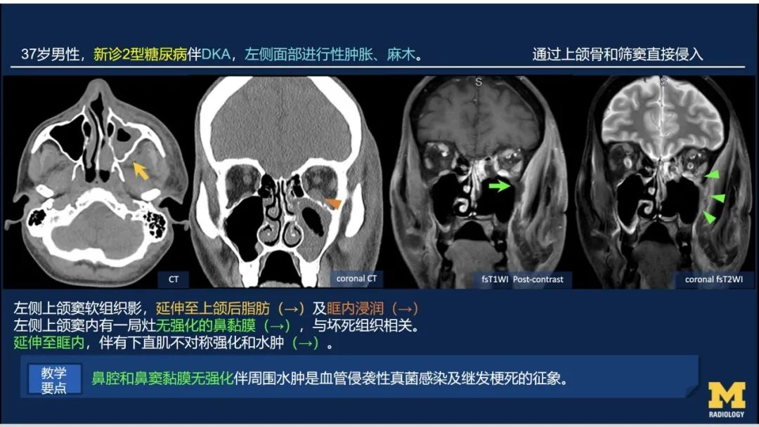 影像PPT - 【PPT】致命的真菌：头颈部侵入性真菌感染-25