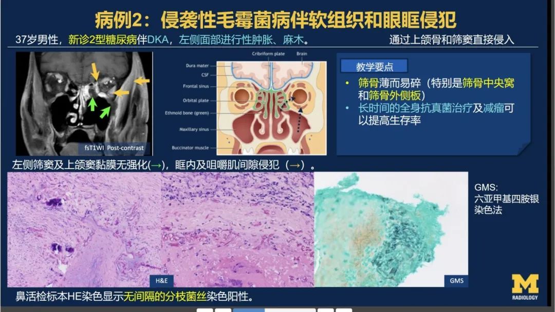 影像PPT - 【PPT】致命的真菌：头颈部侵入性真菌感染-27