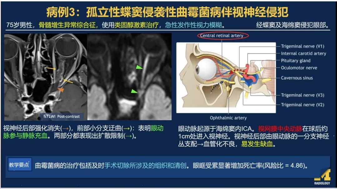 影像PPT - 【PPT】致命的真菌：头颈部侵入性真菌感染-31