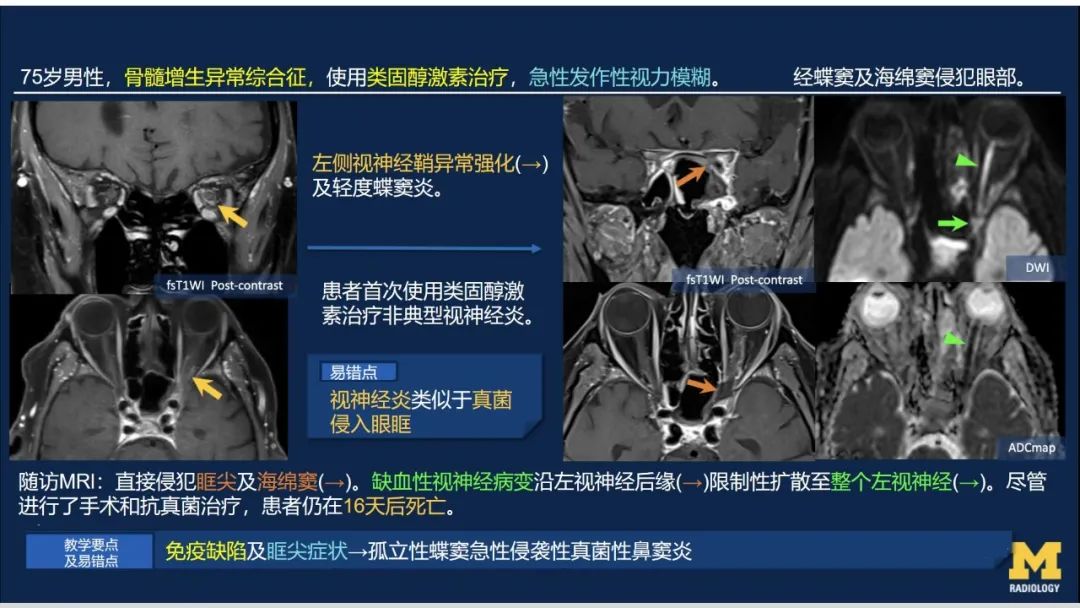 影像PPT - 【PPT】致命的真菌：头颈部侵入性真菌感染-29