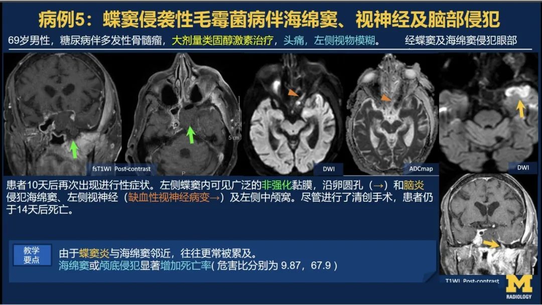 影像PPT - 【PPT】致命的真菌：头颈部侵入性真菌感染-37