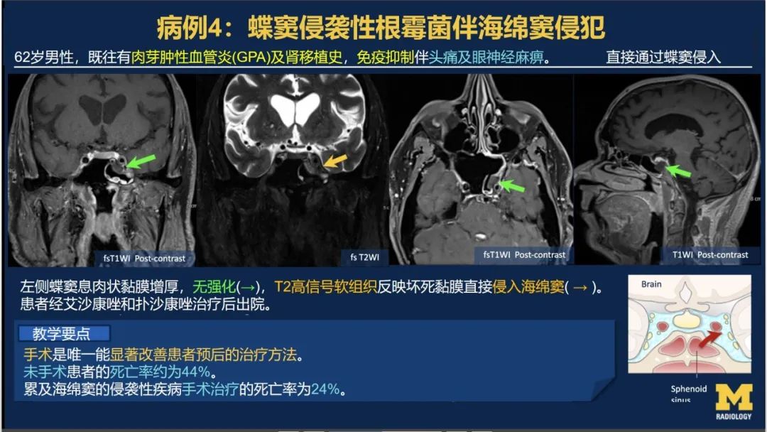 影像PPT - 【PPT】致命的真菌：头颈部侵入性真菌感染-33