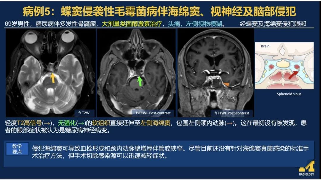 影像PPT - 【PPT】致命的真菌：头颈部侵入性真菌感染-35