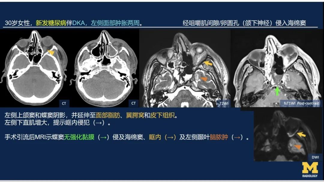 影像PPT - 【PPT】致命的真菌：头颈部侵入性真菌感染-39