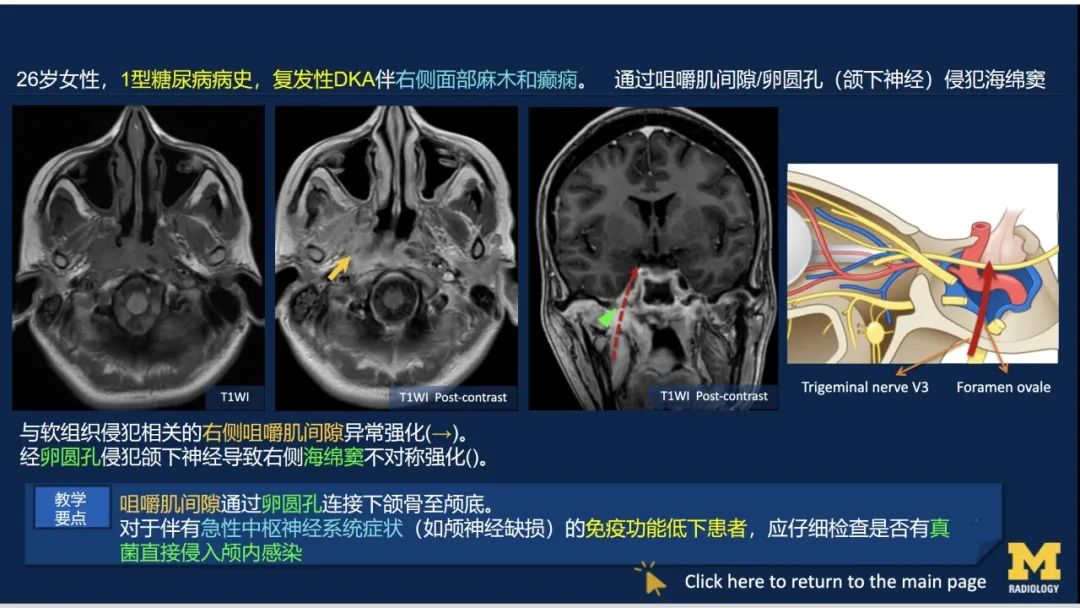 影像PPT - 【PPT】致命的真菌：头颈部侵入性真菌感染-43