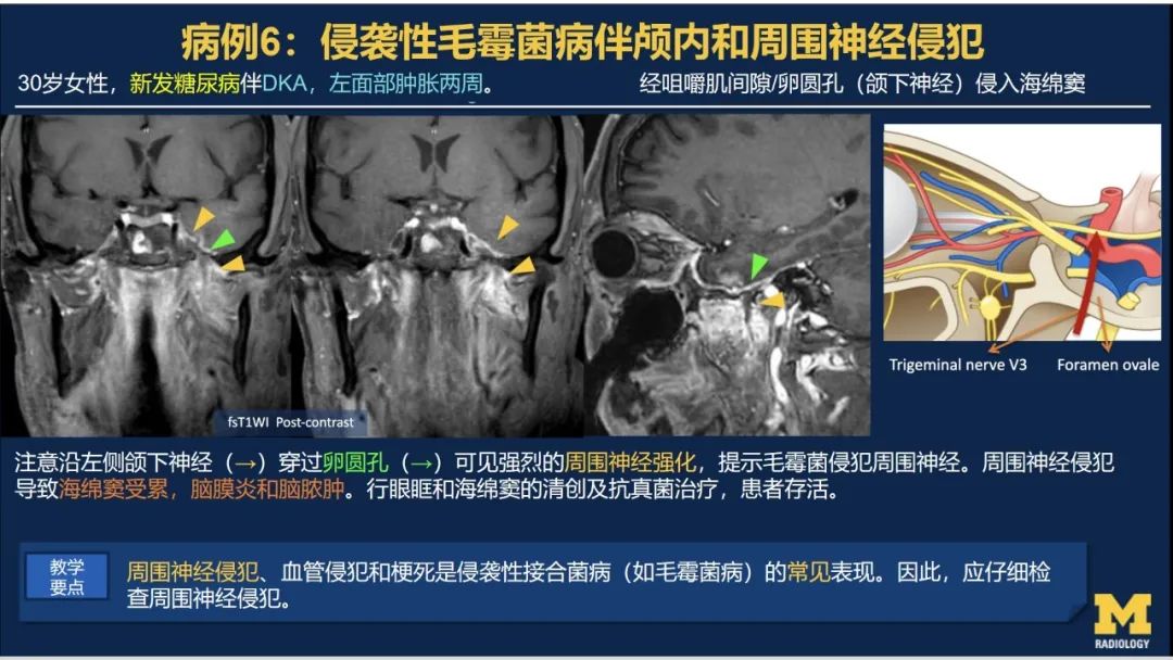 影像PPT - 【PPT】致命的真菌：头颈部侵入性真菌感染-41