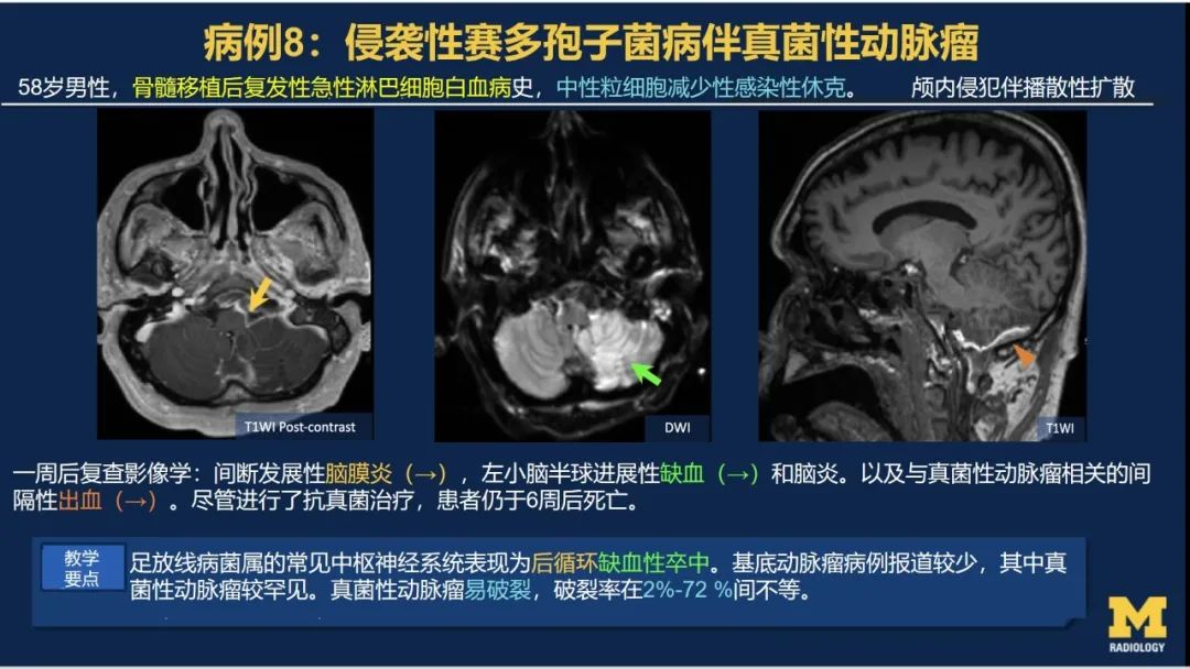 影像PPT - 【PPT】致命的真菌：头颈部侵入性真菌感染-49