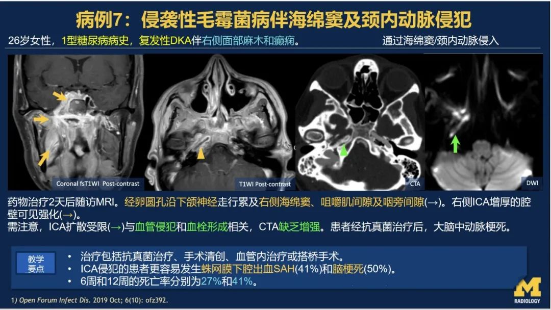 影像PPT - 【PPT】致命的真菌：头颈部侵入性真菌感染-45