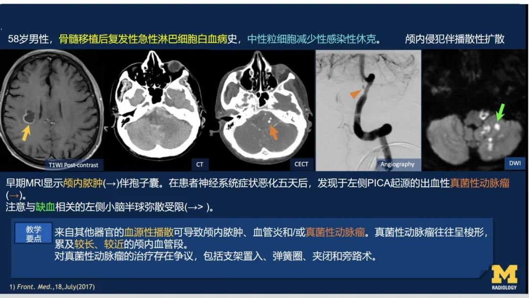 影像PPT - 【PPT】致命的真菌：头颈部侵入性真菌感染-47
