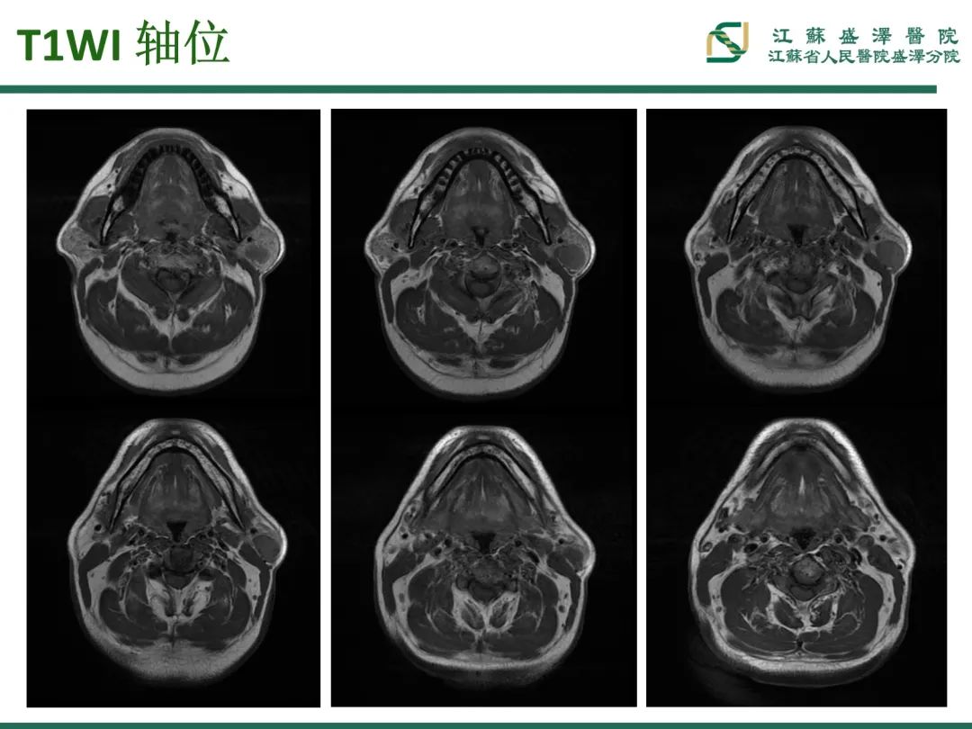 影像PPT - 【PPT】腮腺腺淋巴瘤-3