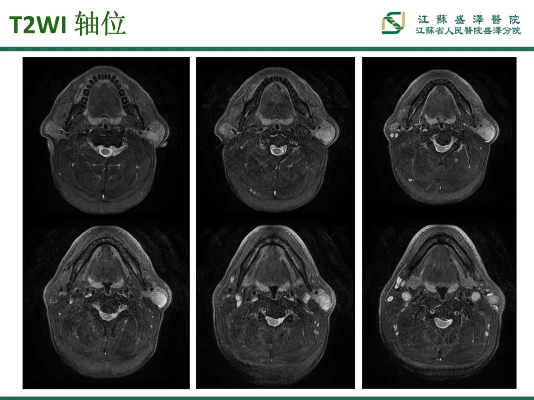 影像PPT - 【PPT】腮腺腺淋巴瘤-4