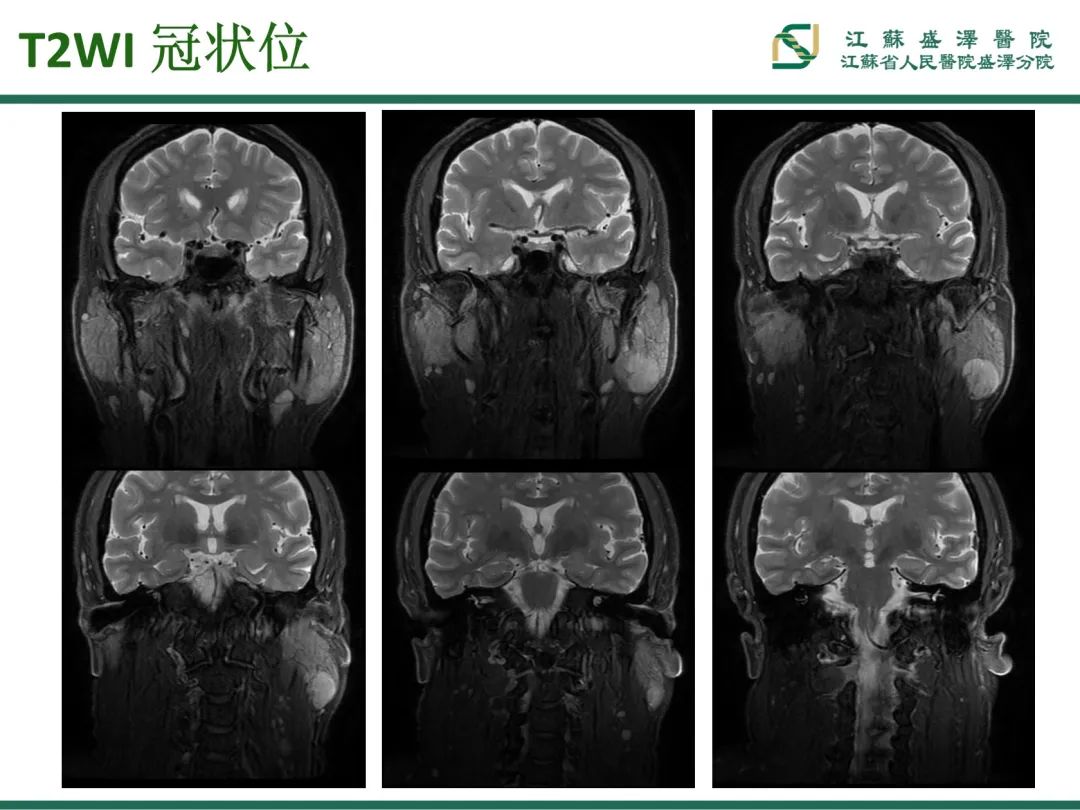 影像PPT - 【PPT】腮腺腺淋巴瘤-5