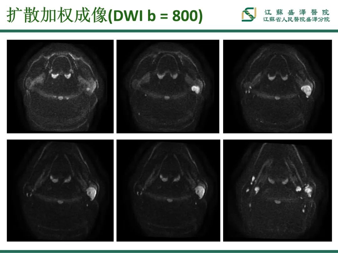 影像PPT - 【PPT】腮腺腺淋巴瘤-6
