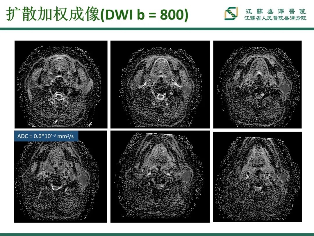 影像PPT - 【PPT】腮腺腺淋巴瘤-7