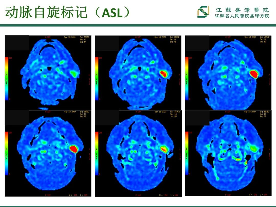 影像PPT - 【PPT】腮腺腺淋巴瘤-8