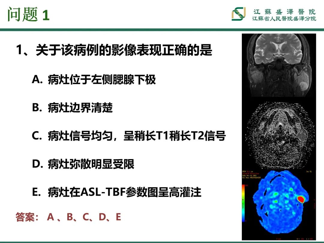影像PPT - 【PPT】腮腺腺淋巴瘤-10