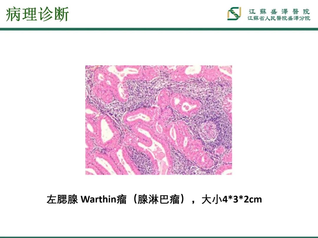 影像PPT - 【PPT】腮腺腺淋巴瘤-13