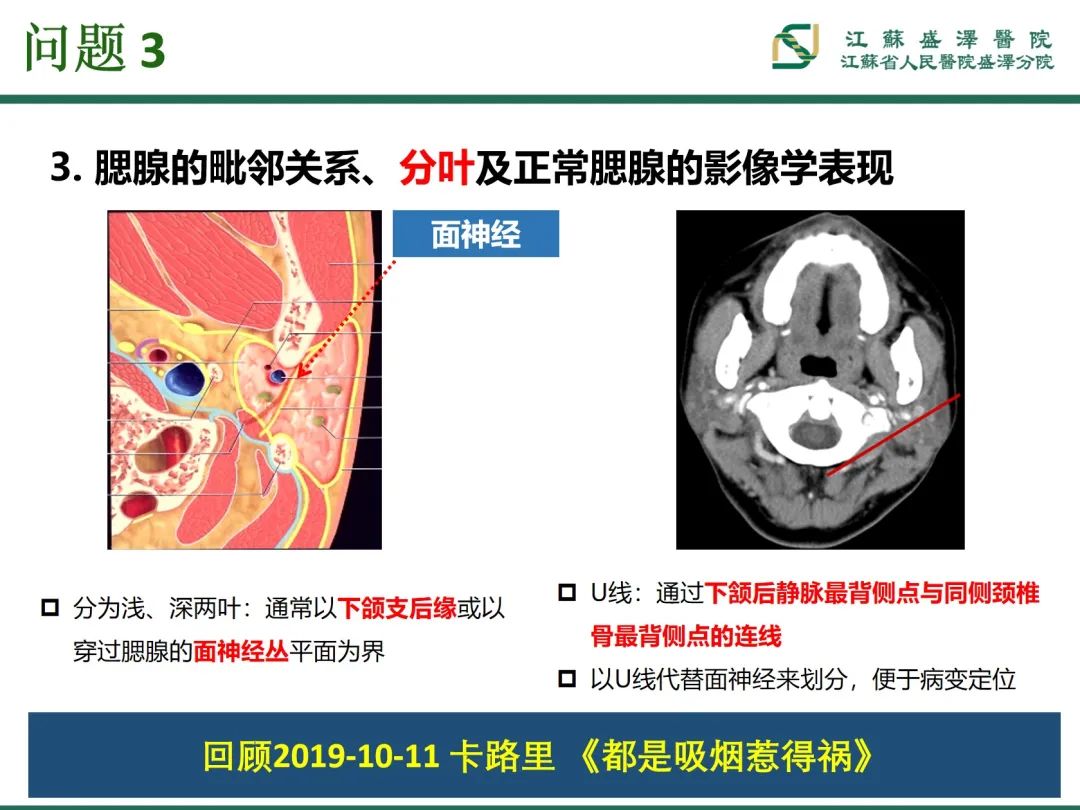 影像PPT - 【PPT】腮腺腺淋巴瘤-16