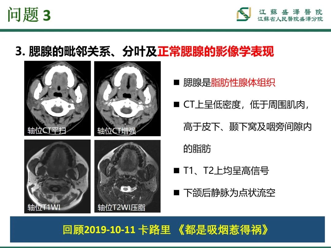 影像PPT - 【PPT】腮腺腺淋巴瘤-17