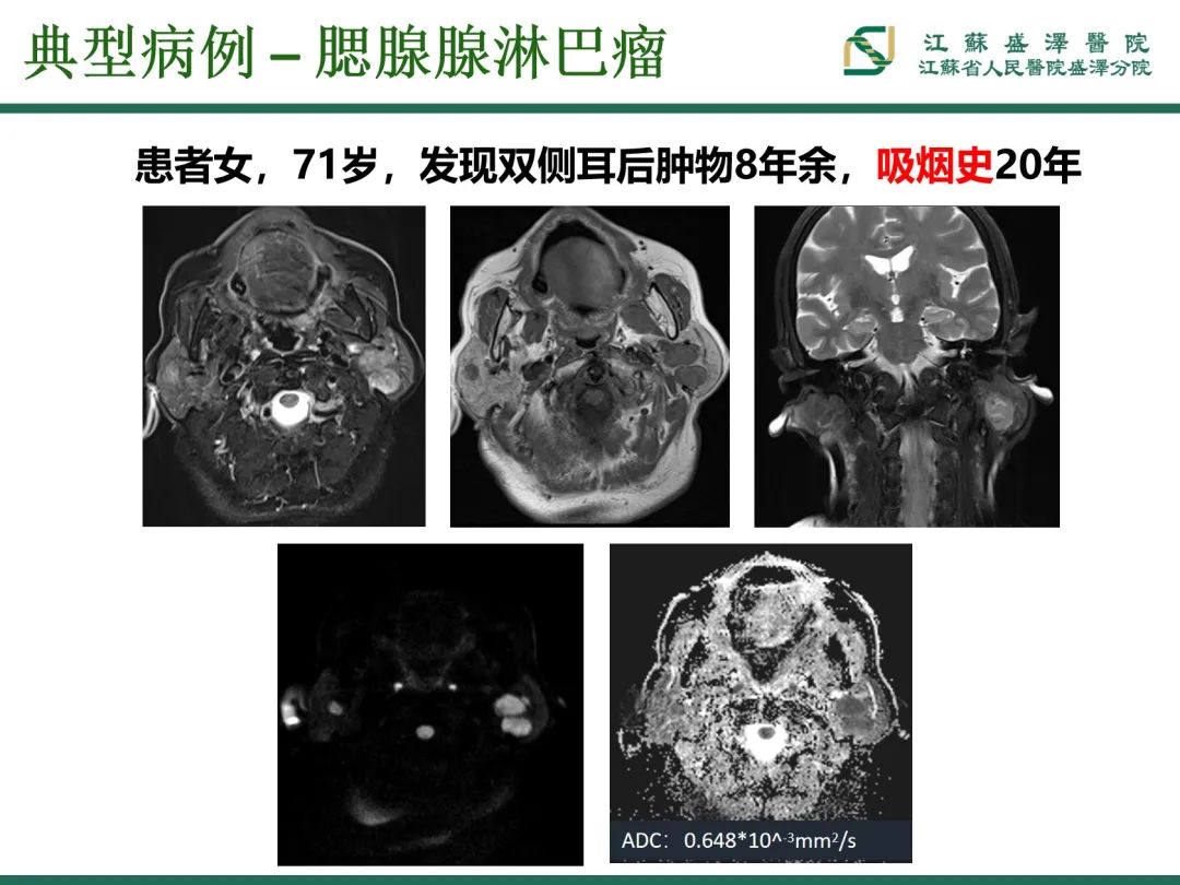 影像PPT - 【PPT】腮腺腺淋巴瘤-22