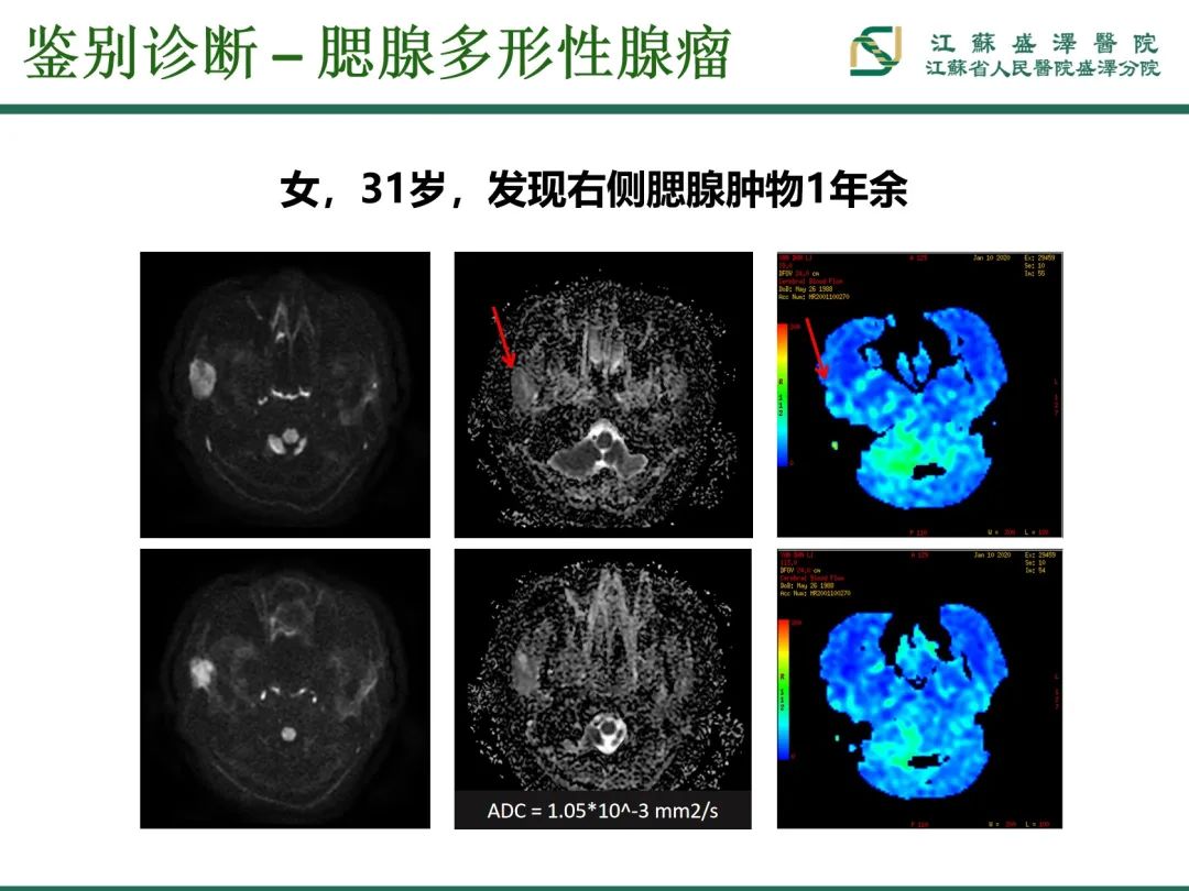 影像PPT - 【PPT】腮腺腺淋巴瘤-24