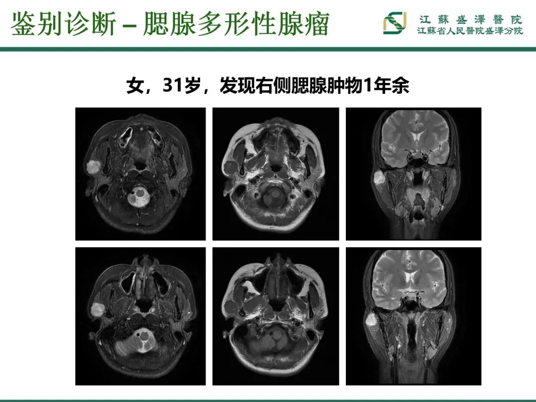 影像PPT - 【PPT】腮腺腺淋巴瘤-23