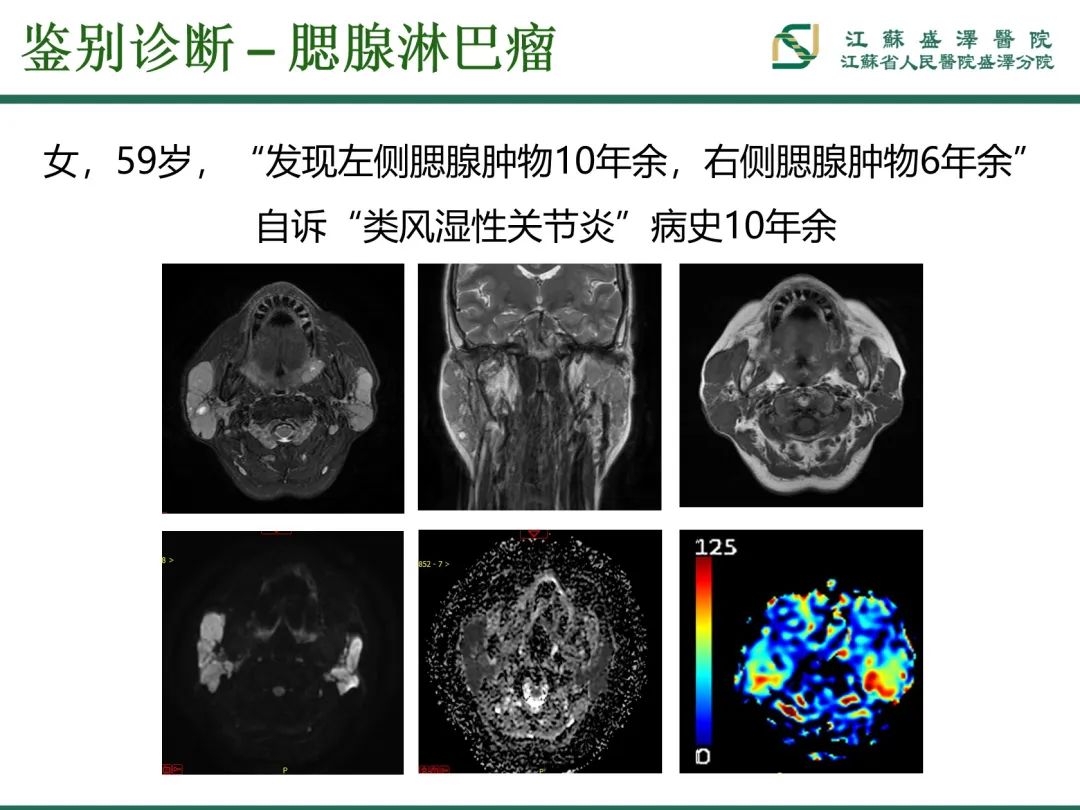 影像PPT - 【PPT】腮腺腺淋巴瘤-27