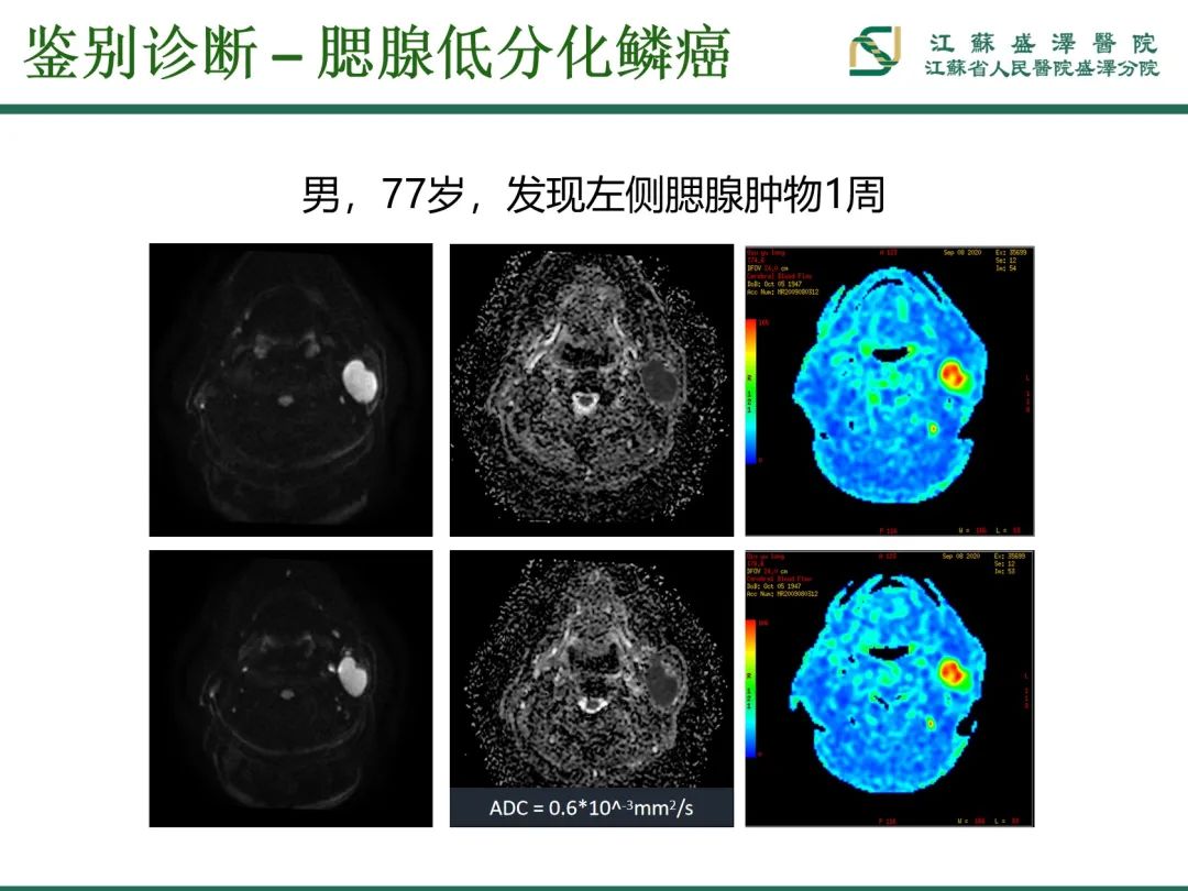 影像PPT - 【PPT】腮腺腺淋巴瘤-26