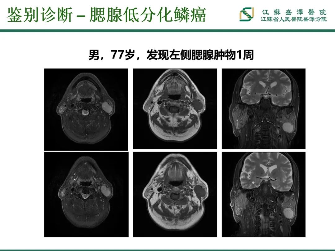 影像PPT - 【PPT】腮腺腺淋巴瘤-25