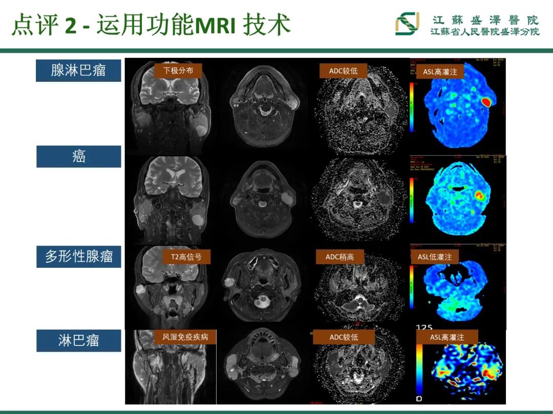 影像PPT - 【PPT】腮腺腺淋巴瘤-33