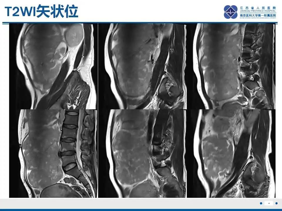 影像PPT - 【PPT】卵巢环状小管性索肿瘤-5