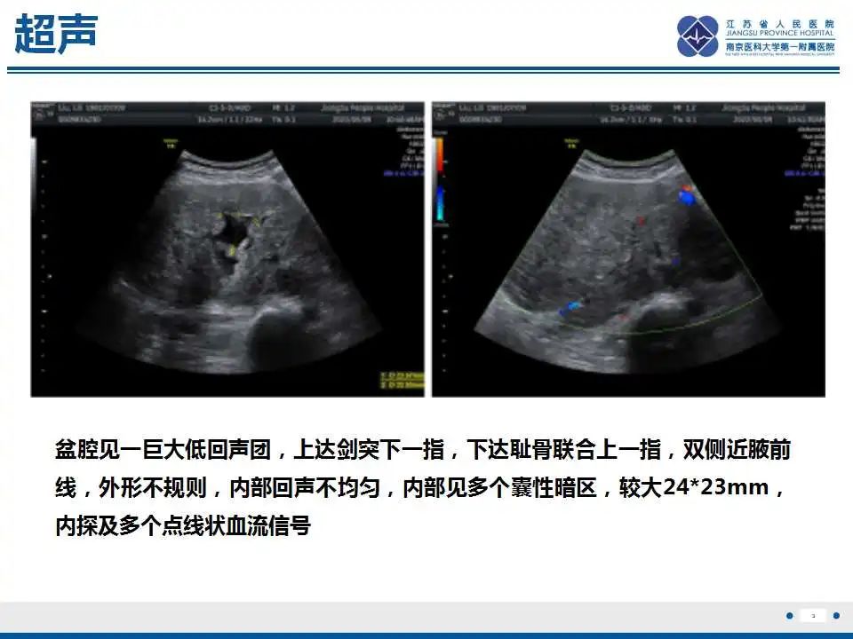 影像PPT - 【PPT】卵巢环状小管性索肿瘤-4