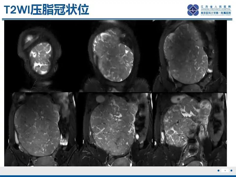 影像PPT - 【PPT】卵巢环状小管性索肿瘤-6