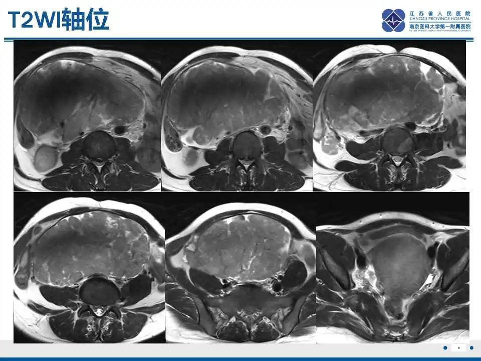 影像PPT - 【PPT】卵巢环状小管性索肿瘤-7