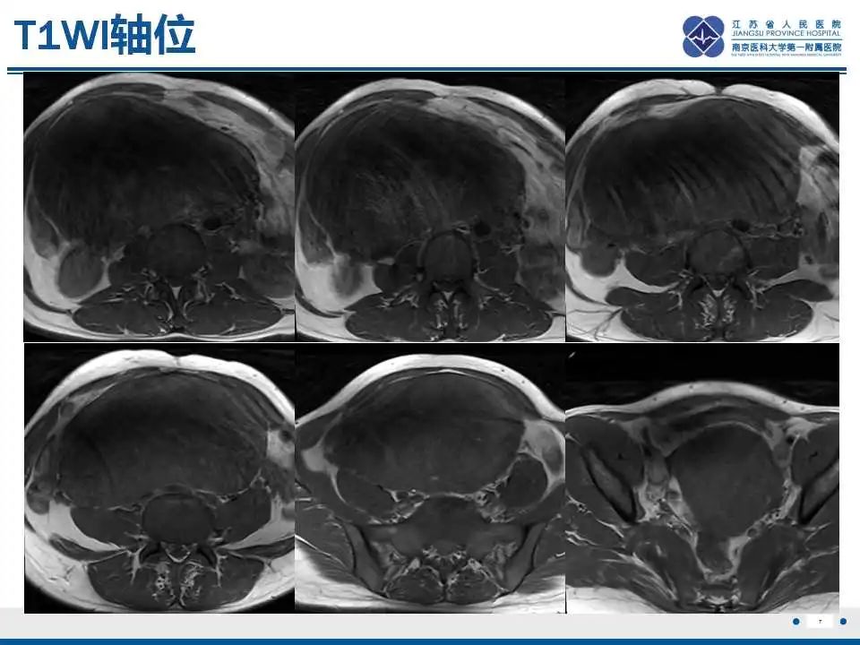 影像PPT - 【PPT】卵巢环状小管性索肿瘤-8