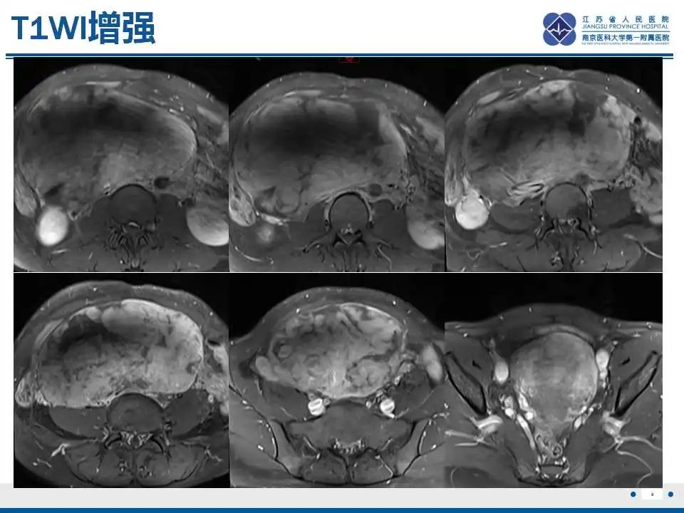 影像PPT - 【PPT】卵巢环状小管性索肿瘤-9