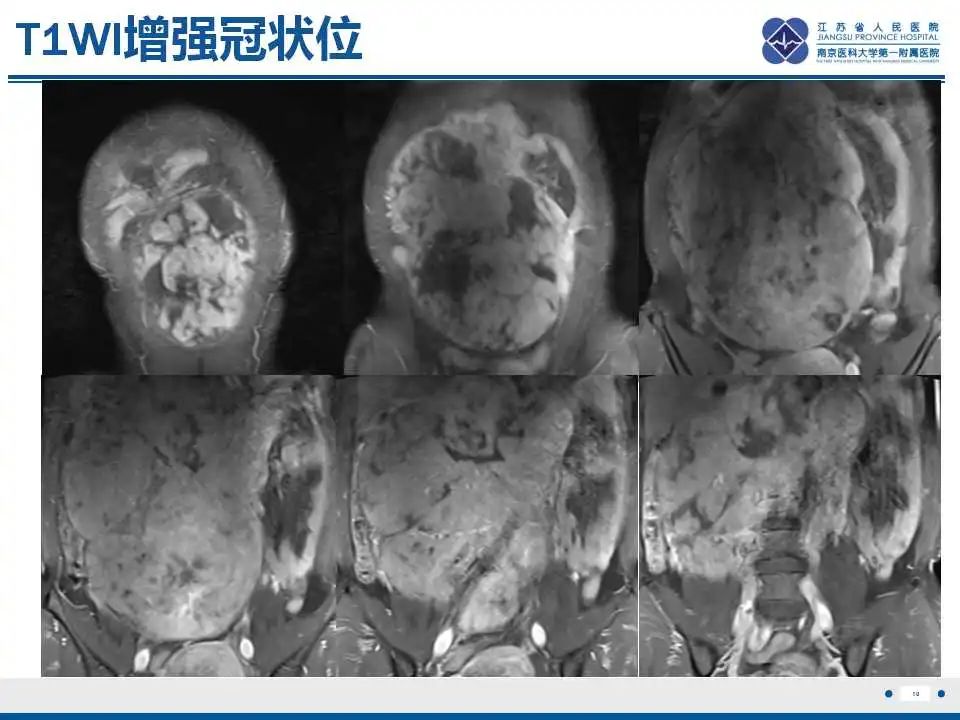影像PPT - 【PPT】卵巢环状小管性索肿瘤-11