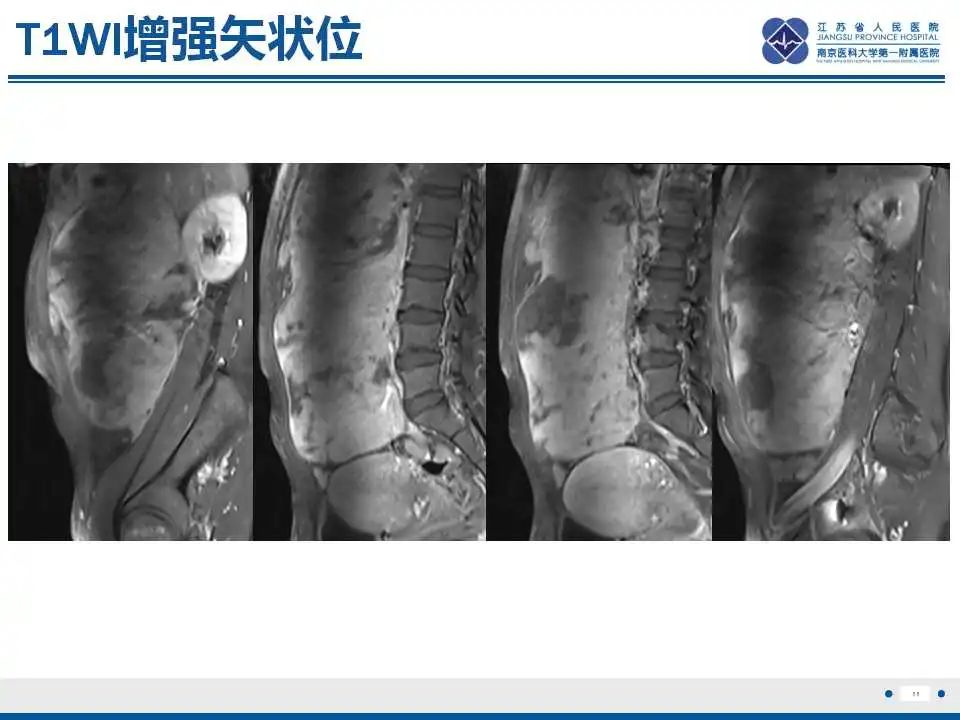 影像PPT - 【PPT】卵巢环状小管性索肿瘤-12