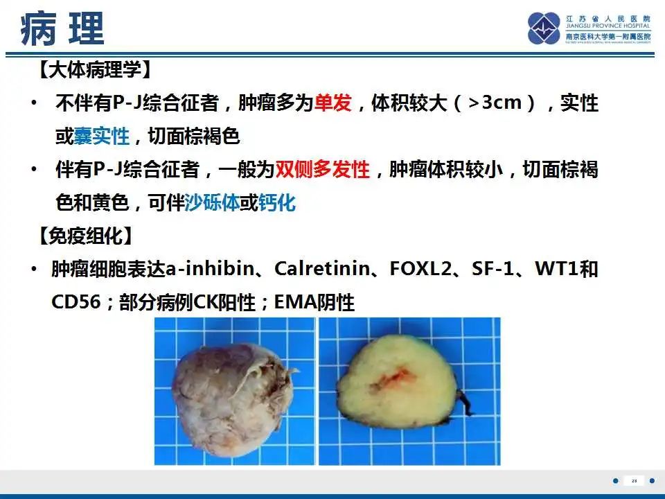 影像PPT - 【PPT】卵巢环状小管性索肿瘤-29