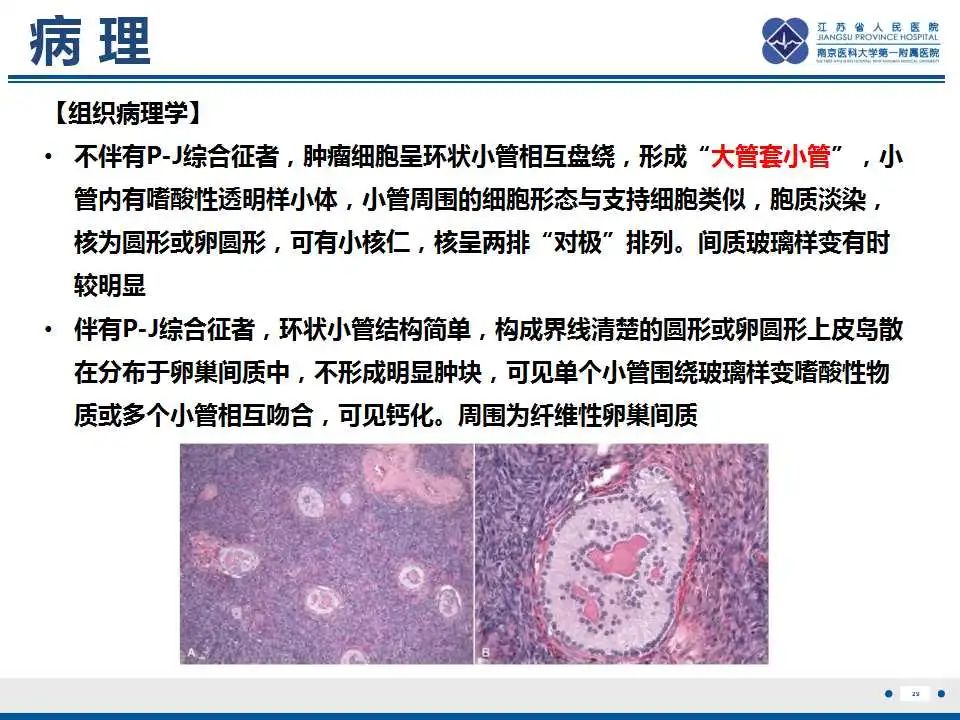 影像PPT - 【PPT】卵巢环状小管性索肿瘤-30