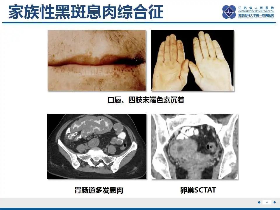 影像PPT - 【PPT】卵巢环状小管性索肿瘤-28