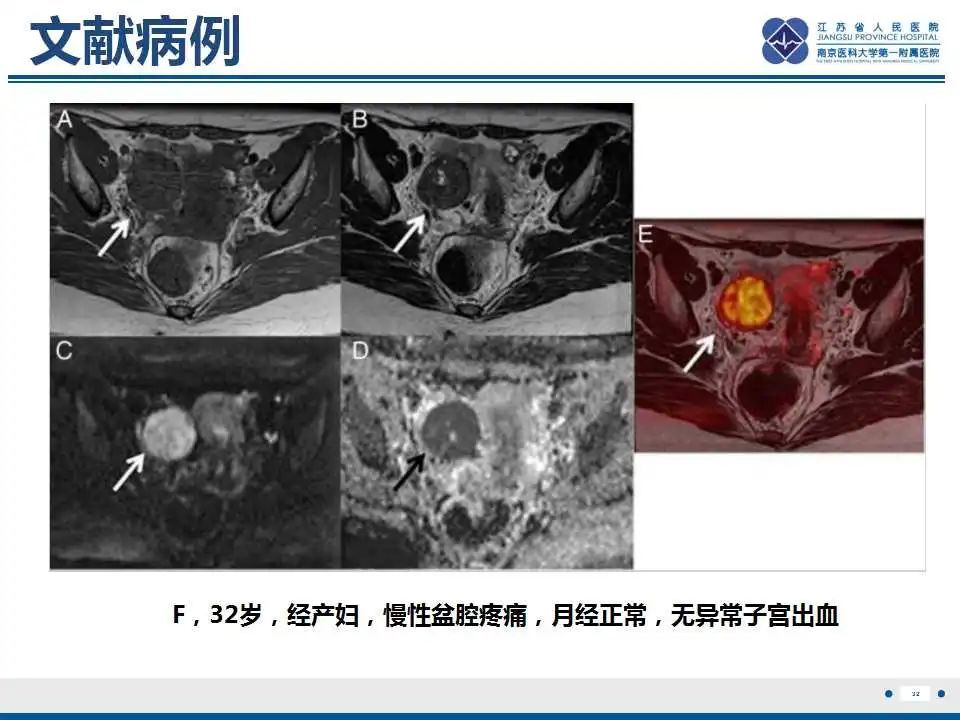 影像PPT - 【PPT】卵巢环状小管性索肿瘤-33
