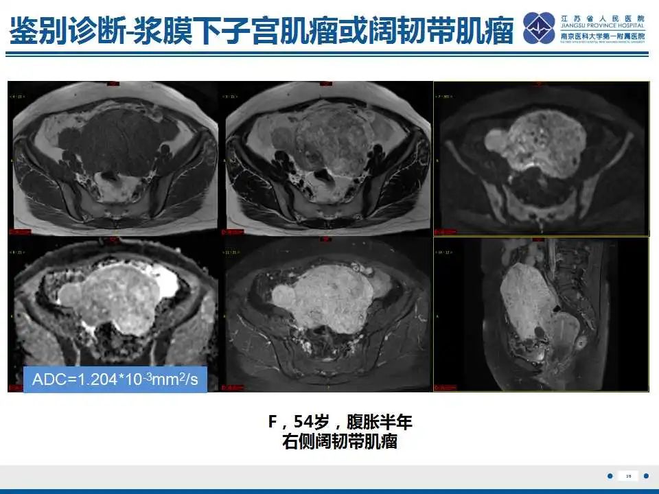 影像PPT - 【PPT】卵巢环状小管性索肿瘤-37