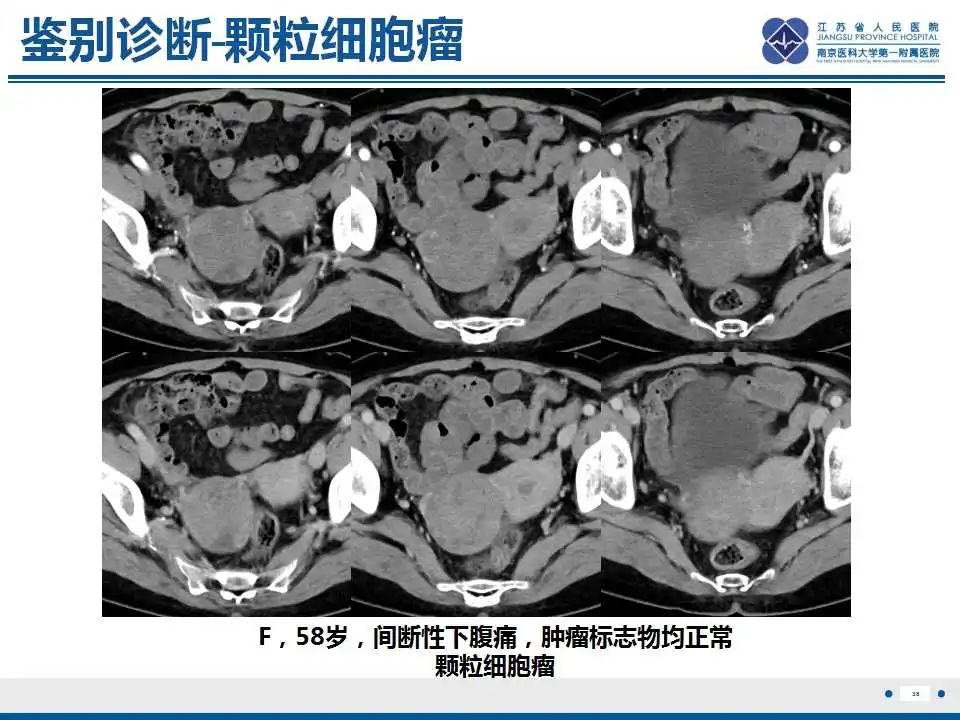 影像PPT - 【PPT】卵巢环状小管性索肿瘤-39
