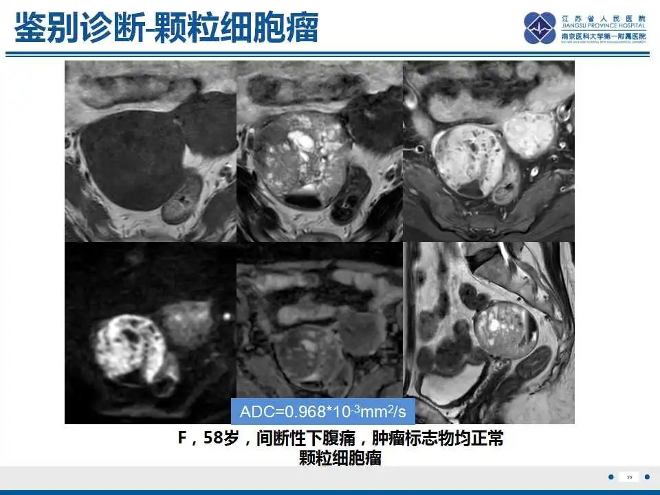 影像PPT - 【PPT】卵巢环状小管性索肿瘤-40