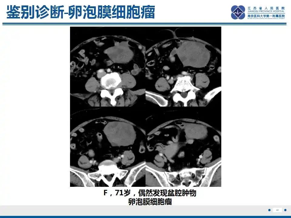 影像PPT - 【PPT】卵巢环状小管性索肿瘤-42